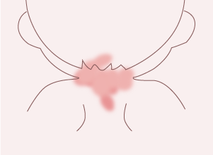 単純性血管腫（ウンナ母斑）