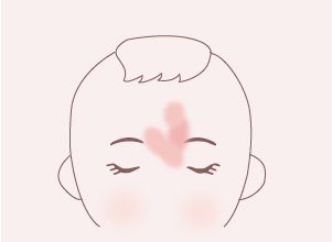 単純性血管腫（サモンパッチ）