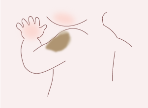 扁平母斑とは？